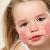 Pakiet badań - alergiczny pediatryczny (27 alergenów)